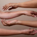 O que é linfedema após câncer de mama: Guia Completo